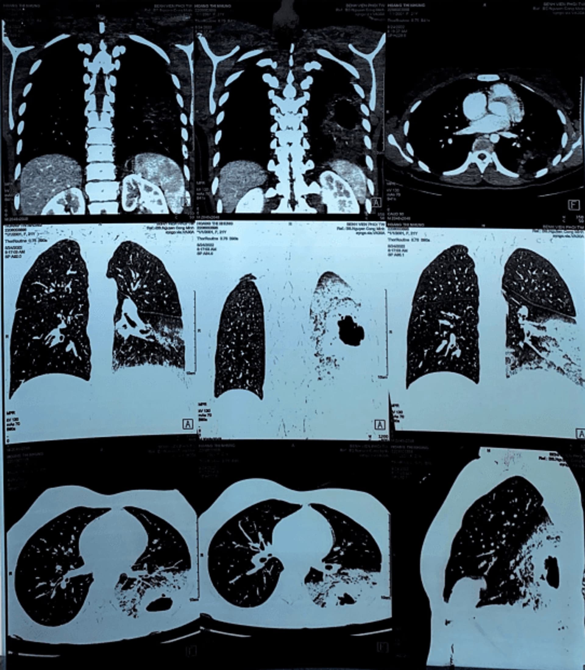 CT NGỰC T8 NĂM 2022 (TRƯỚC MỔ).png