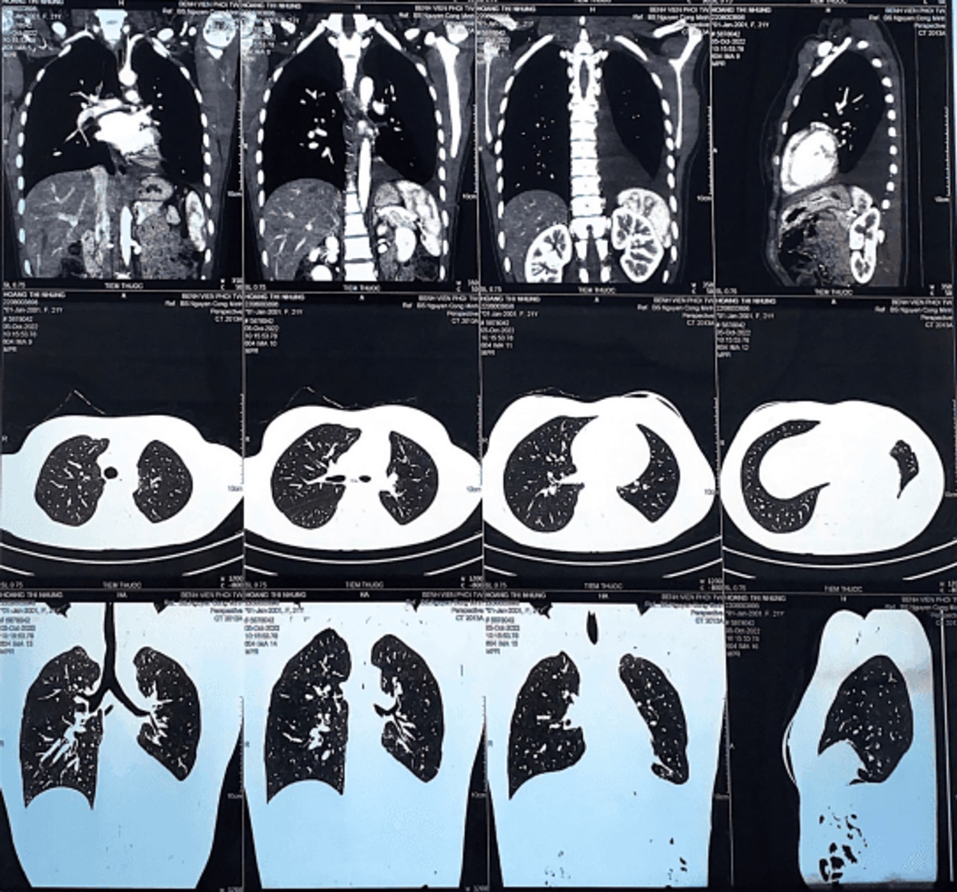CT  NGỰC T9 NĂM 2023 (HIỆN TẠI).png