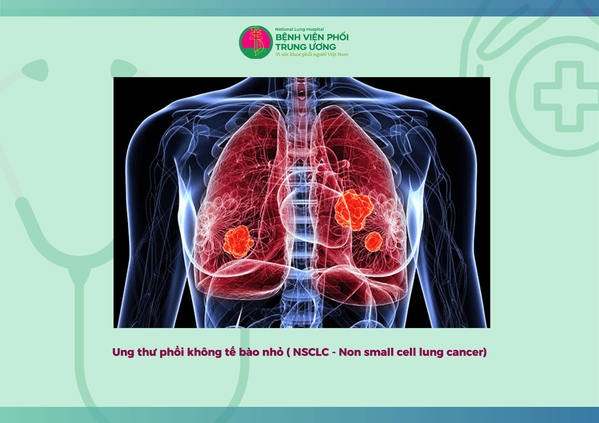 ĐIỀU TRỊ ĐÍCH TRONG UNG THƯ PHỔI KHÔNG TẾ BÀO NHỎ  GIAI ĐOẠN DI CĂN TIẾN XA (2).png