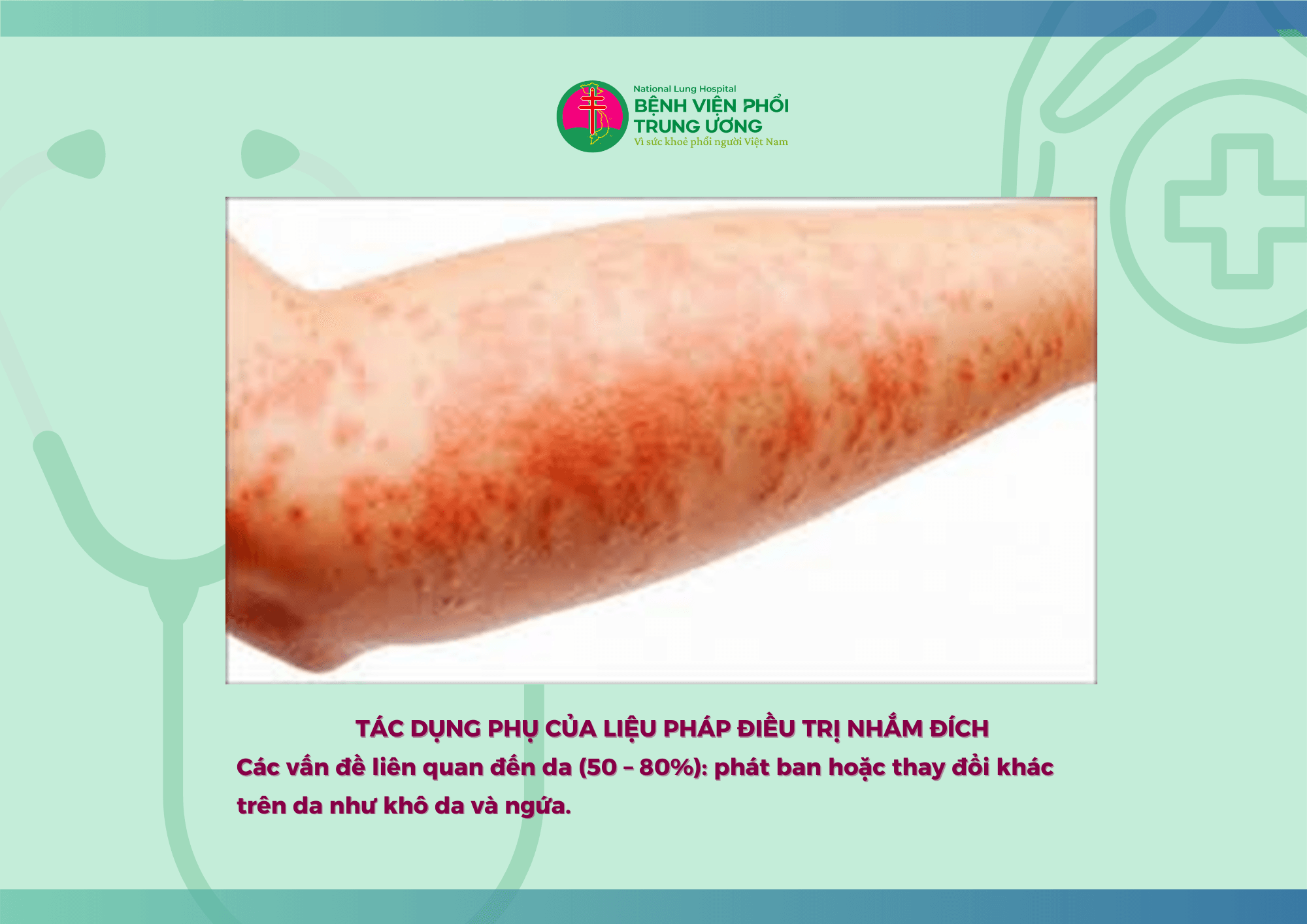 ĐIỀU TRỊ ĐÍCH TRONG UNG THƯ PHỔI KHÔNG TẾ BÀO NHỎ  GIAI ĐOẠN DI CĂN TIẾN XA (4).png