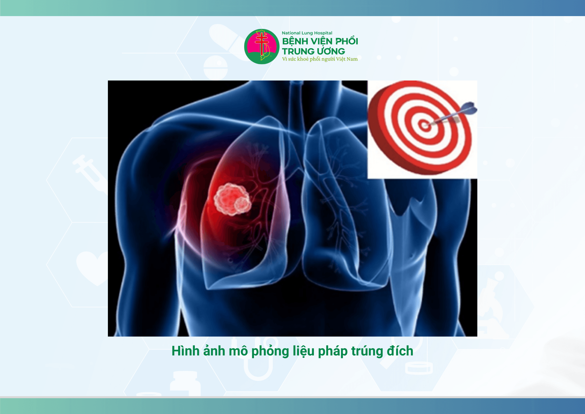HIỆU QUẢ ĐIỀU TRỊ  UNG THƯ PHỔI Không tế bào nhỏ  VỚI LIỆU PHÁP NHẮM ĐÍCH  BẰNG THUỐC THẾ HỆ 1 (2).png