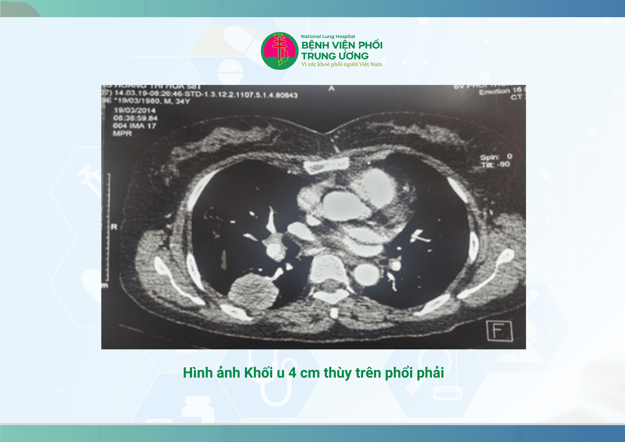HIỆU QUẢ ĐIỀU TRỊ  UNG THƯ PHỔI Không tế bào nhỏ  VỚI LIỆU PHÁP NHẮM ĐÍCH  BẰNG THUỐC THẾ HỆ 1 (3).png
