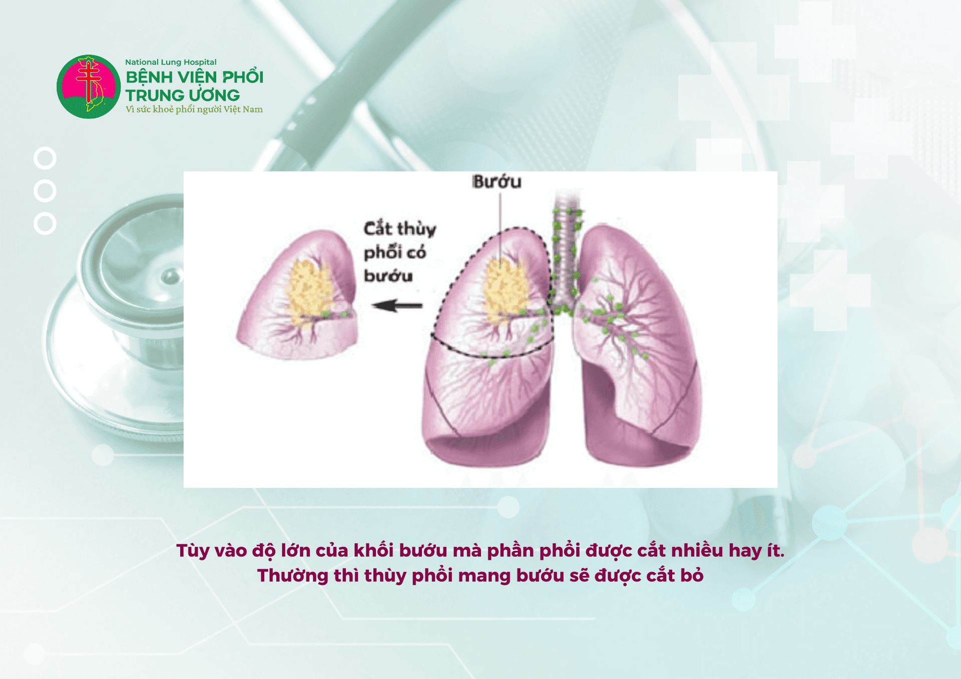 PHẪU THUẬT CHO MỤC TIÊU TRIỆT CĂN UNG THƯ PHỔI (4).png