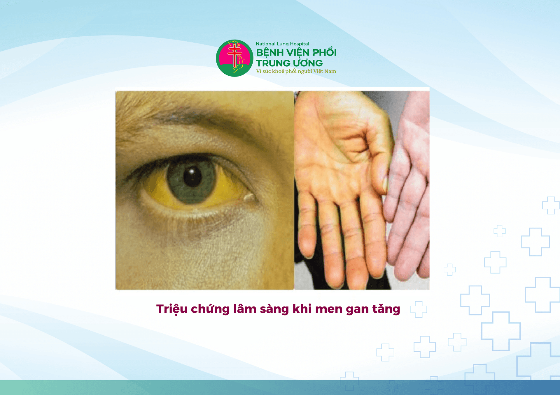 Quản lý tăng men gan ở bệnh nhân ung thư phổi không tế bào nhỏ  có Đột biến gen EGFR (+) có điều trị thuốc ức chế tyrosine kinase (3).png
